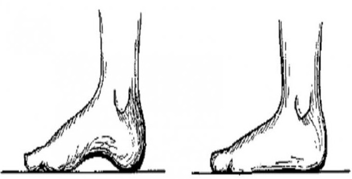 Стопы при плоскостопии 