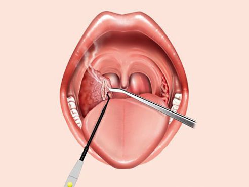 формы тонзиллита