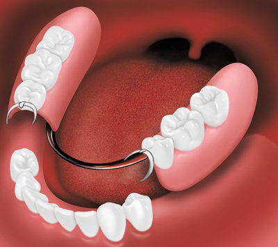 съемный зубной протез сэндвич 