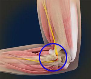 туннельный синдром локтевого нерва 