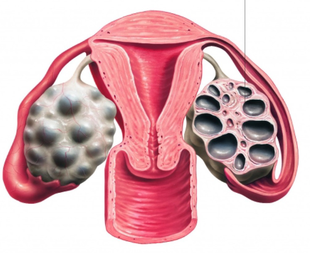 Синдром поликистозных яичников лечение