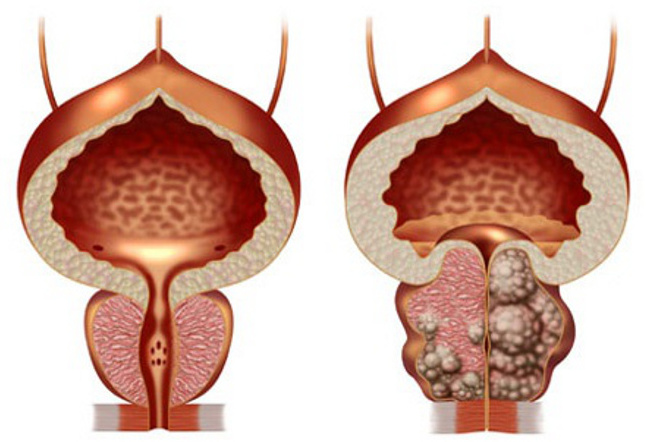 Аденома простаты