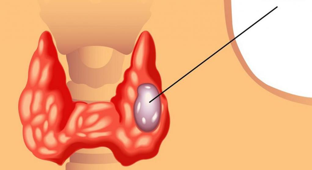 Узловой зоб щитовидной железы