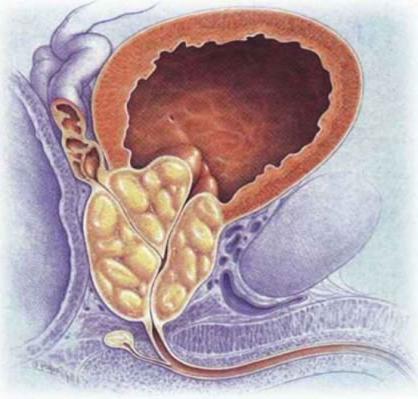 аденома простаты что это 