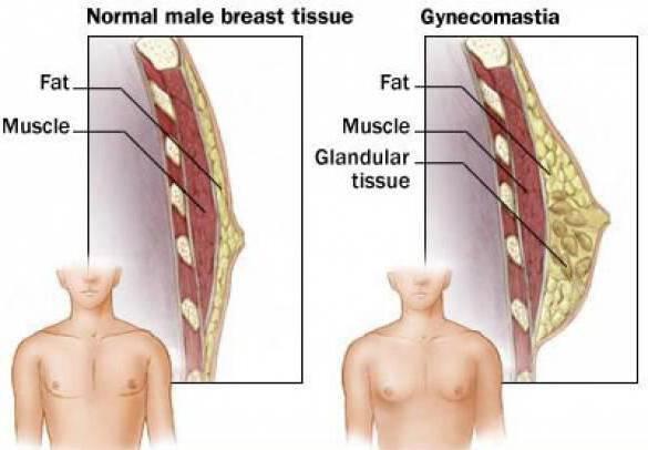 после удаления гинекомастии