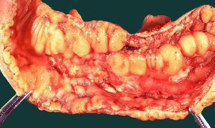 хронический энтероколит