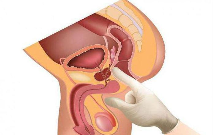 пальцевое исследование прямой кишки