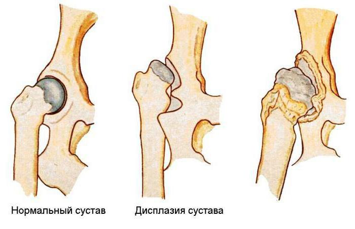 упражнения для исправления утиной походки