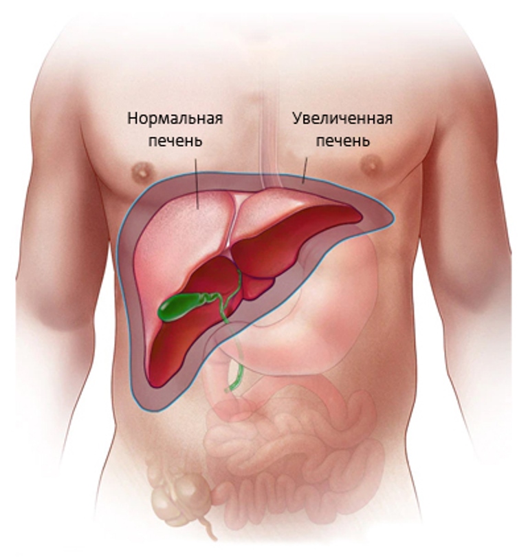 Увеличение печени