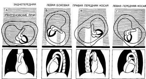 митральная конфигурация сердца