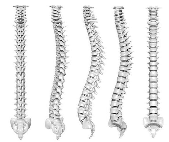 искривление позвоночника лордоз