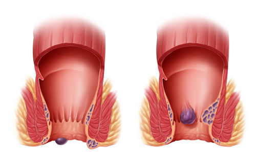 тромбоз геморроидального узла лечение