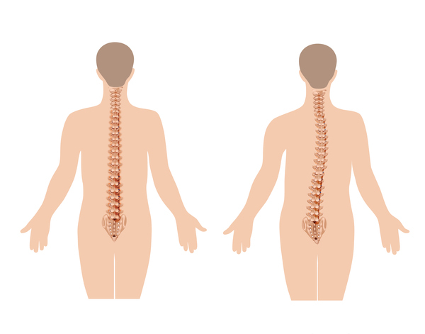как вылечить сколиоз