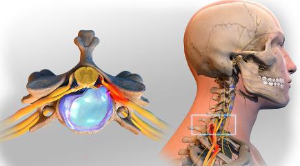 шейная грыжа