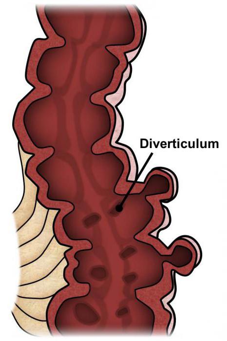дивертикулярная болезнь