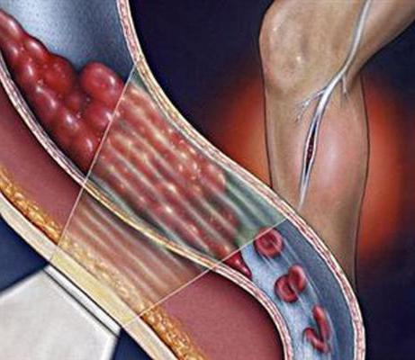 тромбоэмболия нижних конечностей