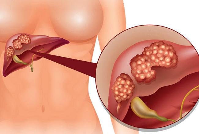 Третья стадия рака печени
