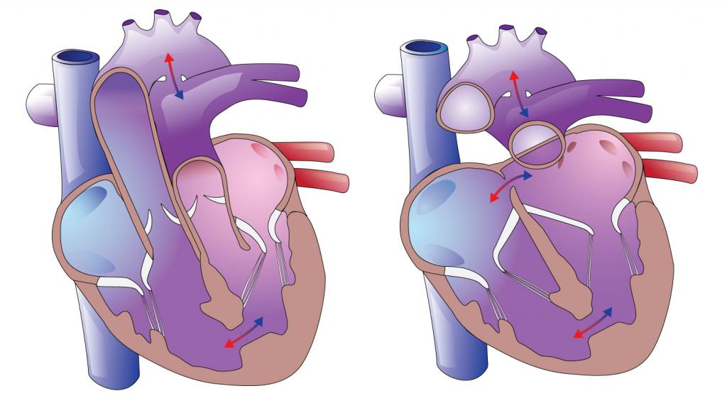 Врожденные пороки сердца
