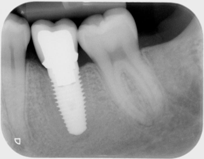 имплантация зубов какие могут быть осложнения