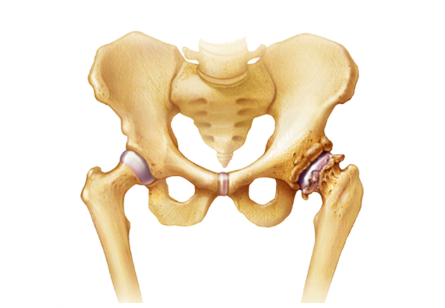 Коксартроз тазобедренного сустава