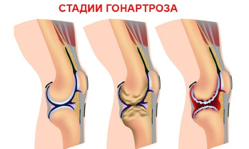 Стадии гонартроза