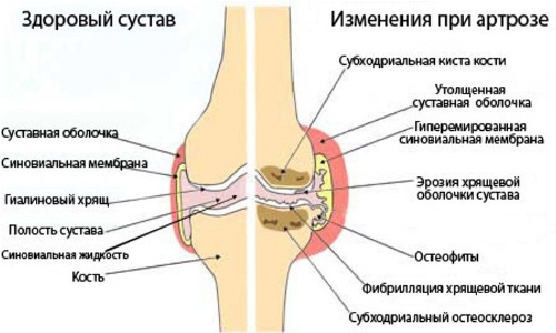 Отличия здорового сустава от больного