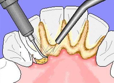 способы удаления зубного налета