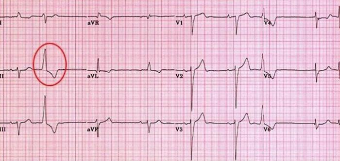 что показывает ЭКГ сердца