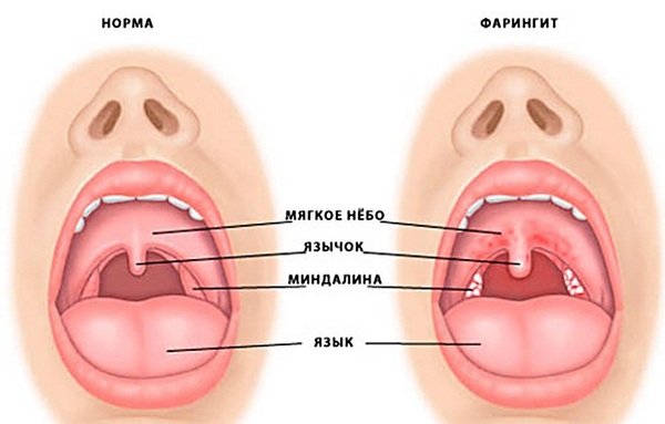 Нормальное и больное горло