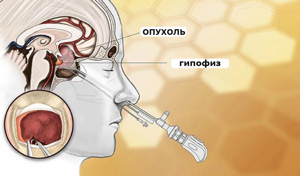 Удаление опухоли гипофиза