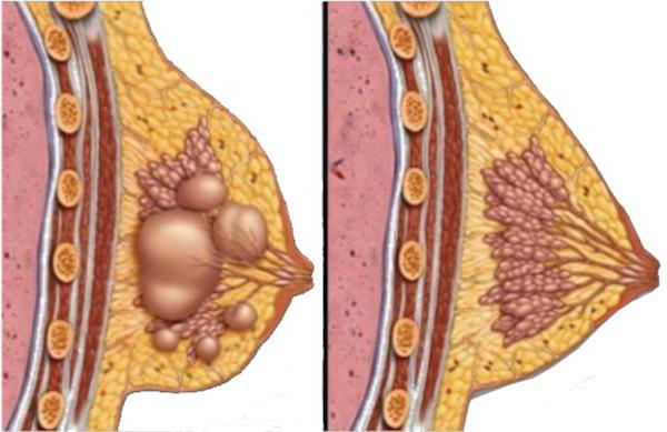 киста грудной железы