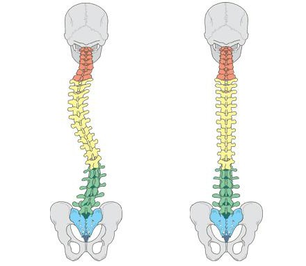 сколиотическая осанка 