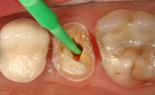 Пломбирование корневых каналов зубов