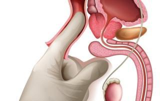 масаж простаты в домашних условиях правильная техника