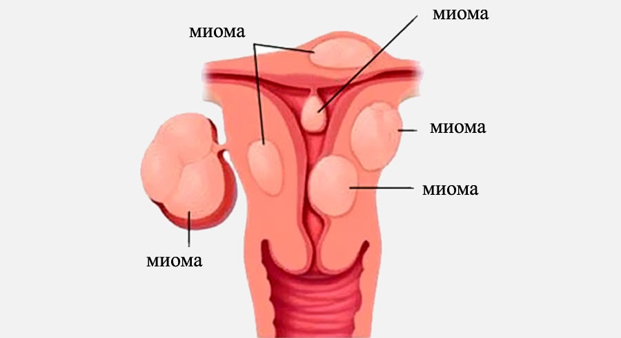 Миома матки у женщин