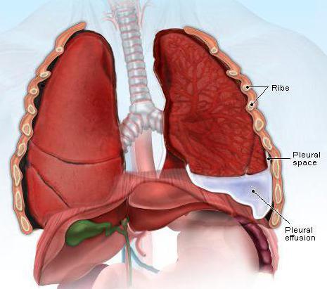 плевральная полость легких