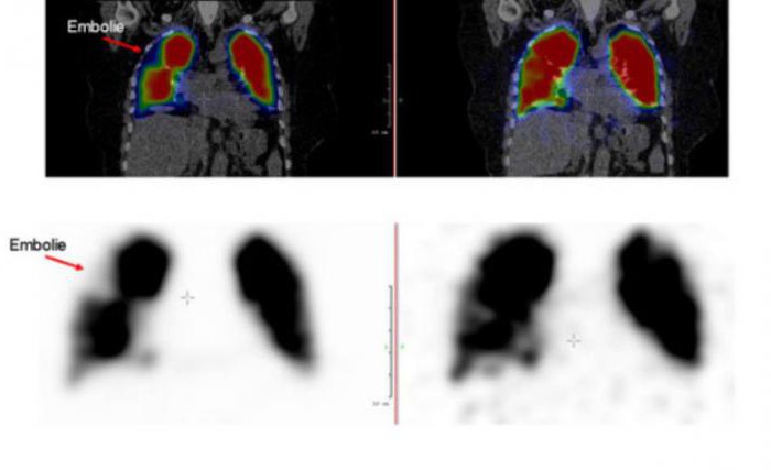 сцинтиграфия легких при тэла