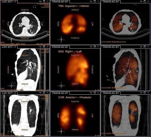 сцинтиграфия легких показания тромбофлебит
