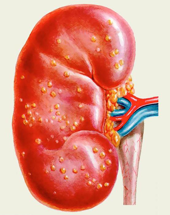 абсцесс почки узи