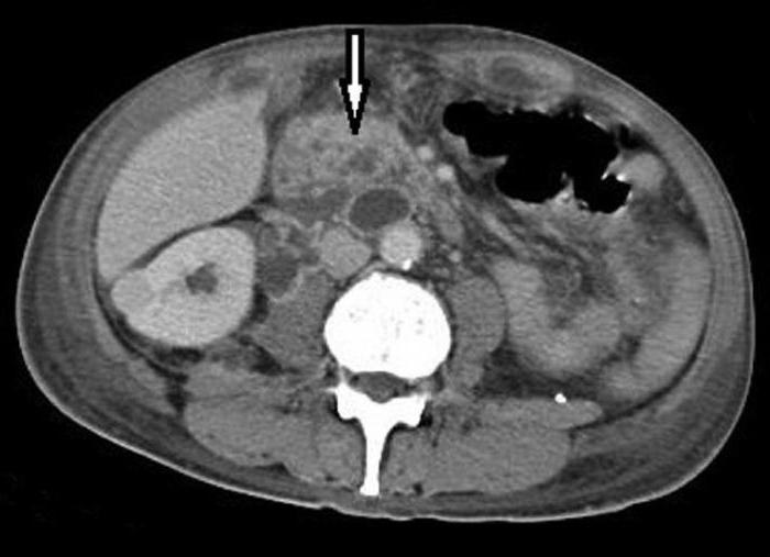 абсцесс почки причины