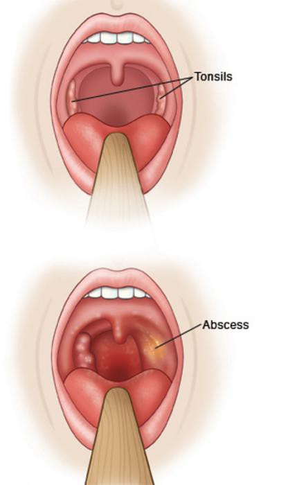 симптомы паратонзиллярного абсцесса