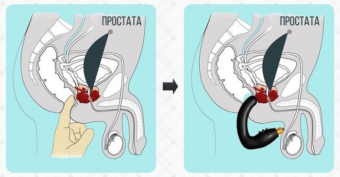 массаж простаты массажером