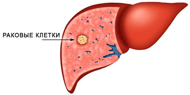 очаговое образование печени что это
