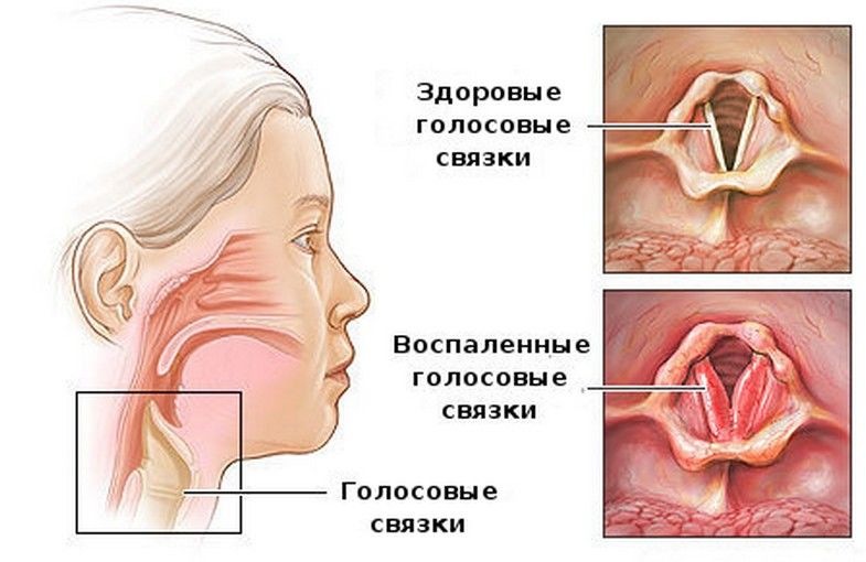 ларинготрахеит лечение у взрослых