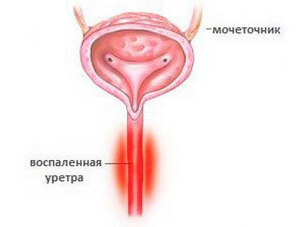 воспаленная уретра