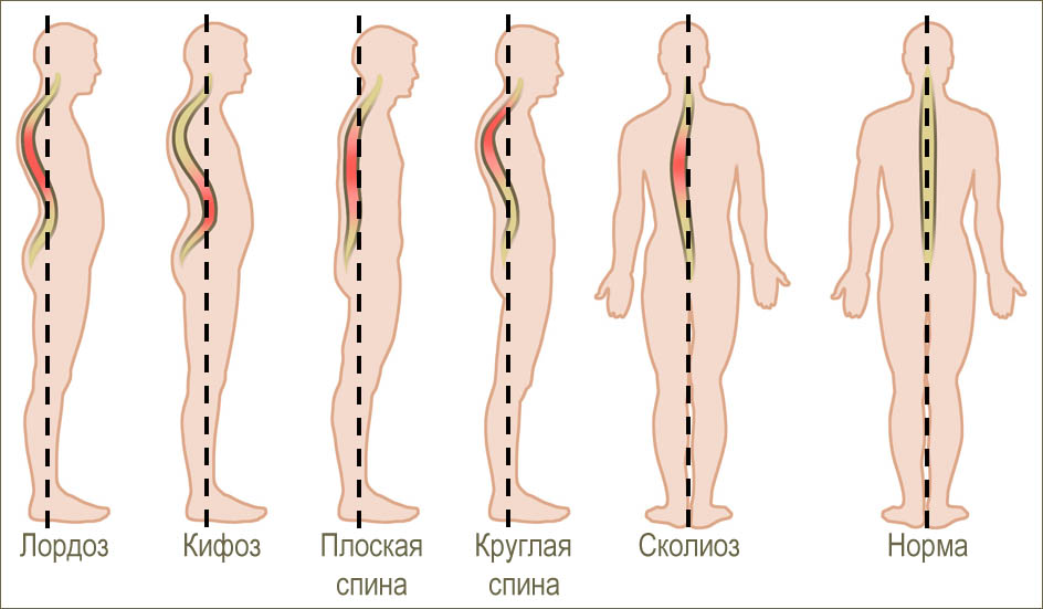 профилактика сколиоза у детей дошкольного возраста