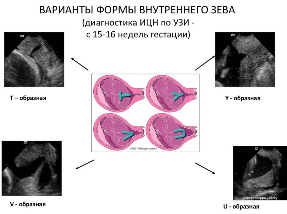 Что такое ицн при беременности