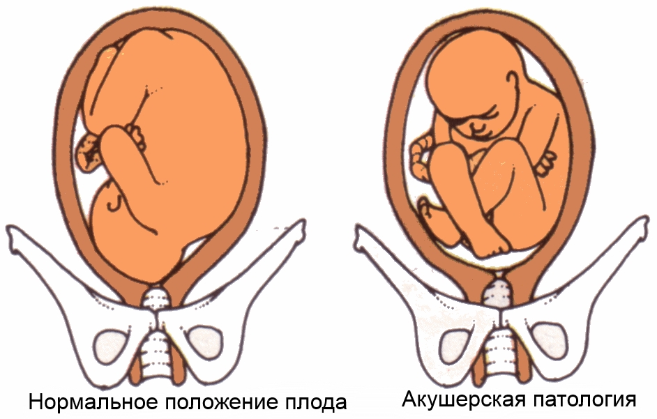 Тазовое предлежание