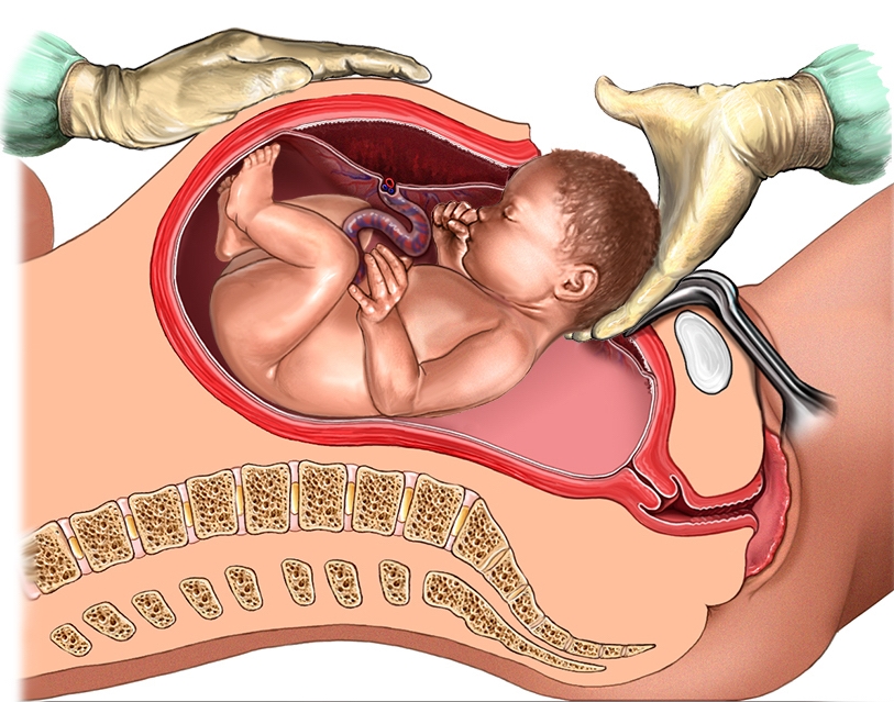 Кесарево сечение при тазовом предлежании