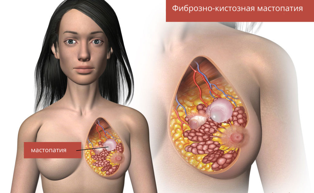 Мастопатия молочной железы